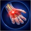 Loss of Grip Strength