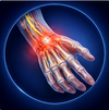 Reduced Hand Nerve Response