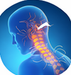Pinched or Irritated Nerves
